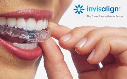 Invisalign-Eindhoven